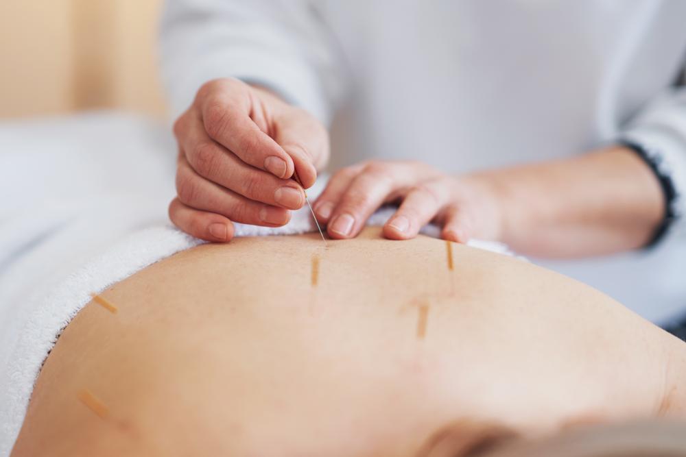 Expert acupuncturists in Calgary offering holistic health services