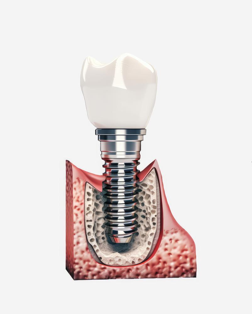 The Benefits of Choosing Dental Implants Melbourne