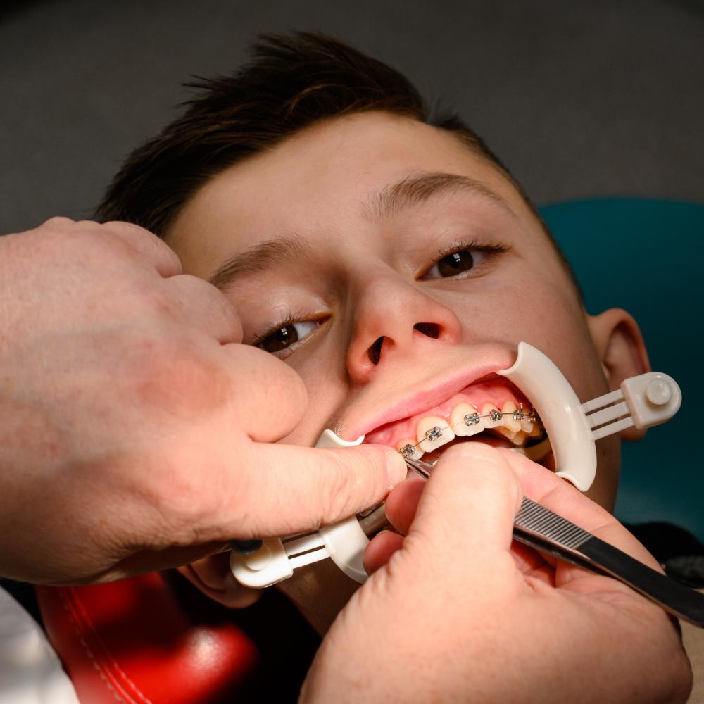The Right Age for Braces