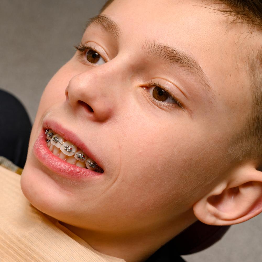 Caring for Braces: Tips and Tricks