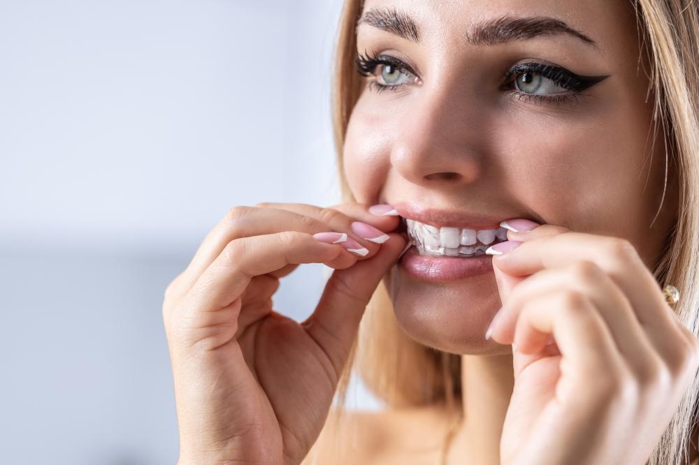 Why Choose Clear Aligners?