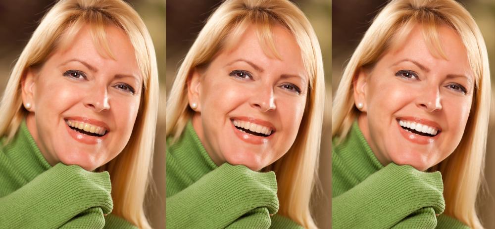 Cosmetic dental patient showcasing teeth whitening results