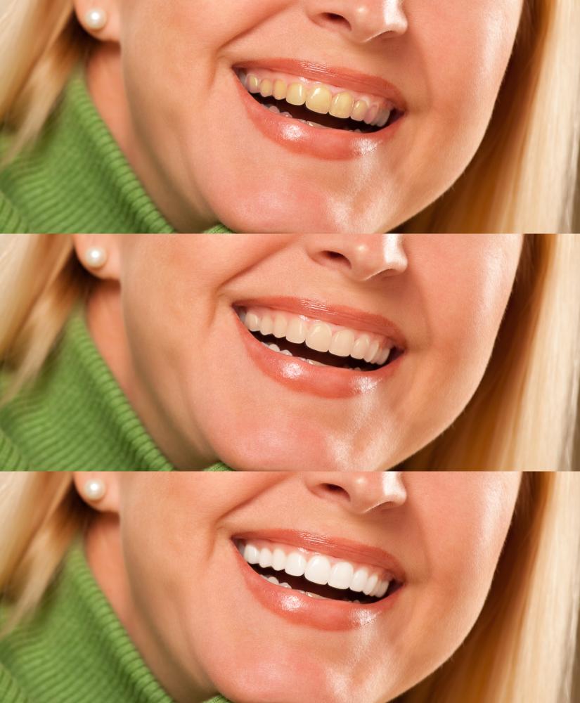 Considering Veneers? Here's What You Should Know