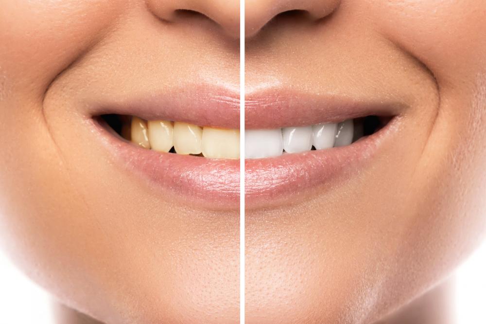 Satisfied patient with color shade guide after teeth whitening
