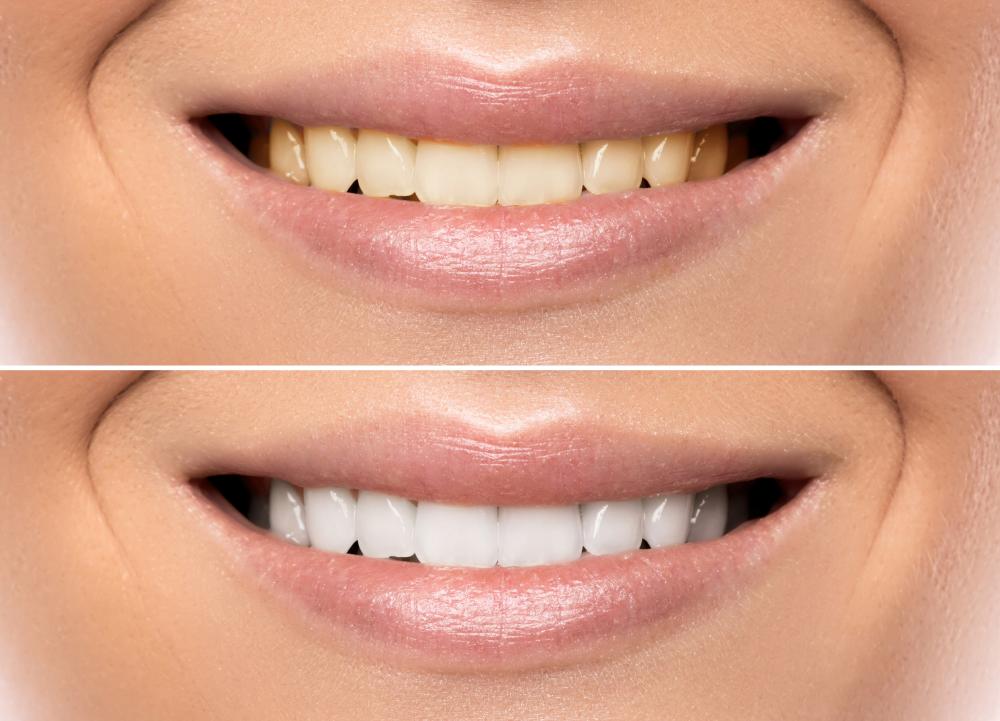 Professional teeth color comparison during Zoom Whitening procedure