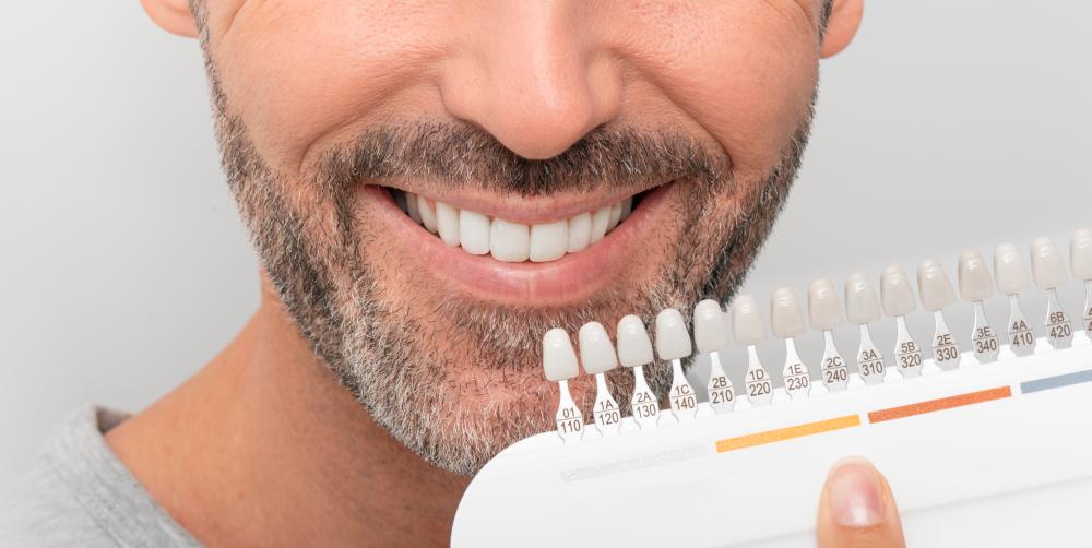 Unveiling the Benefits of Veneers