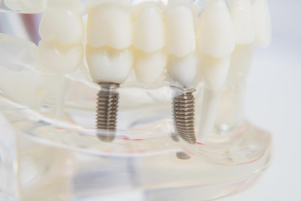 Model teeth with dental implants on a table