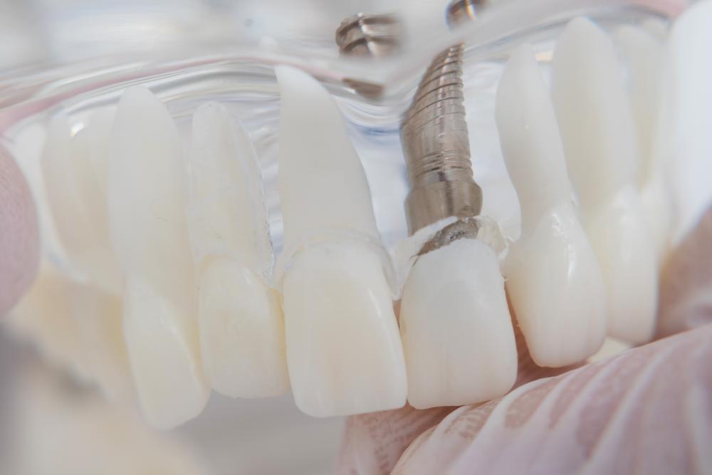 Technological advancements in dental implant procedures in Phoenix