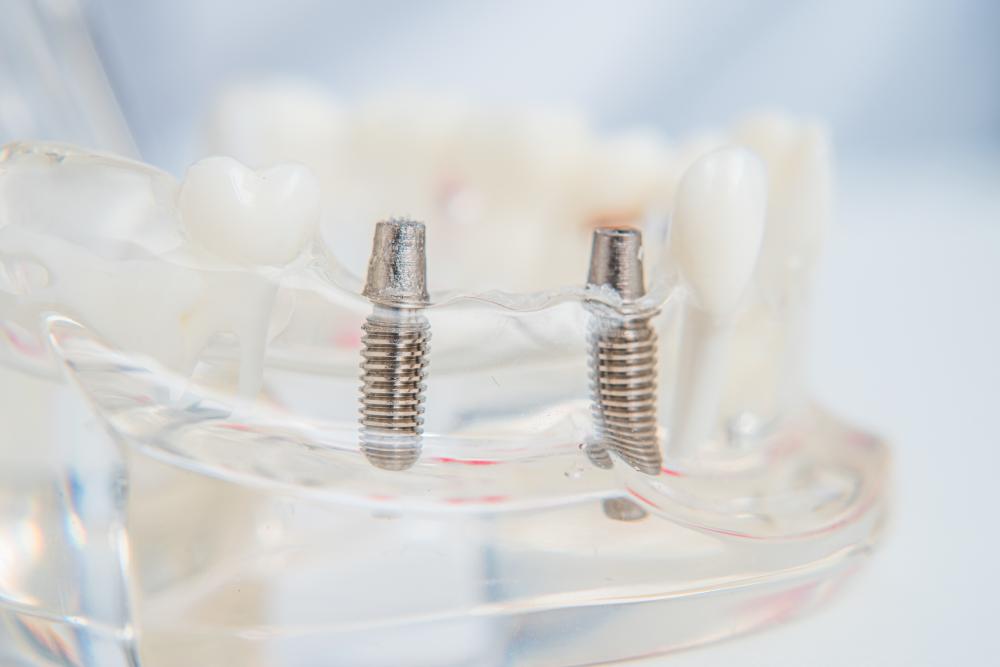 Model of teeth with dental implants on a table