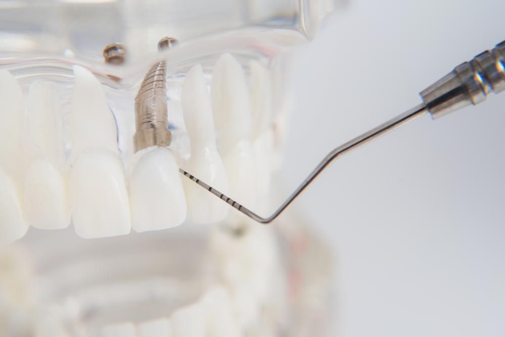 Model of teeth with dental implants highlighting NE Calgary dental solutions