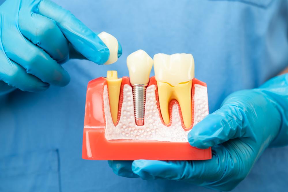Why Choose Dental Implants?