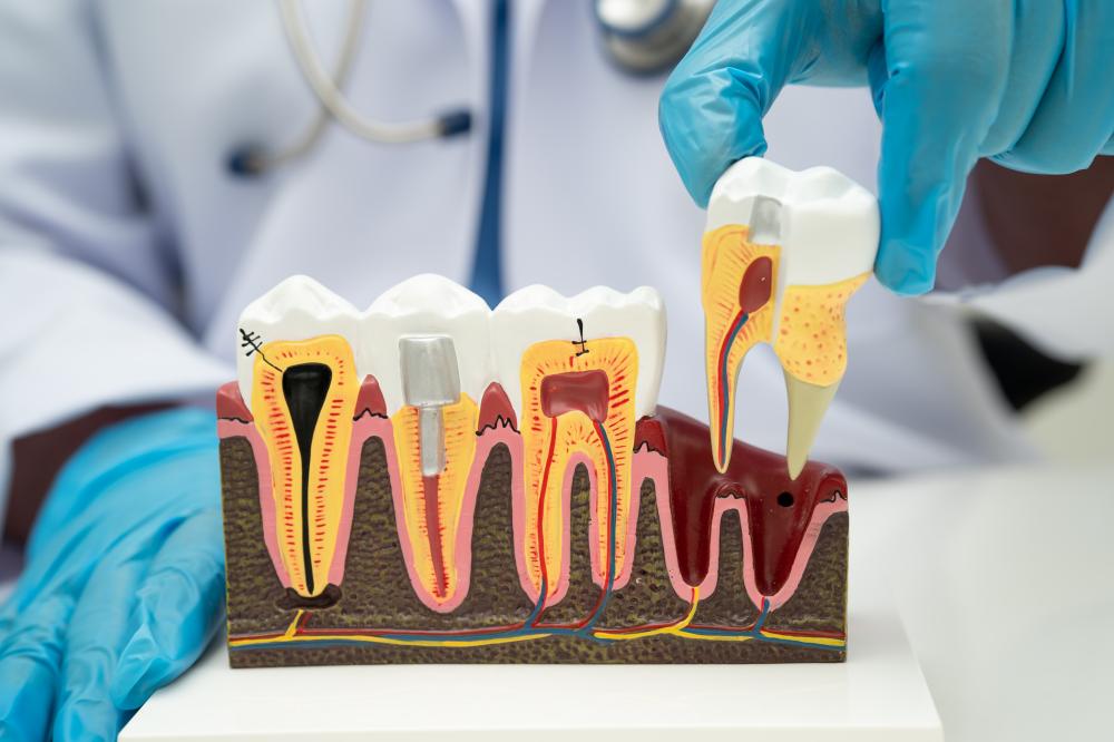 When Do You Need a Root Canal in White Rock BC?
