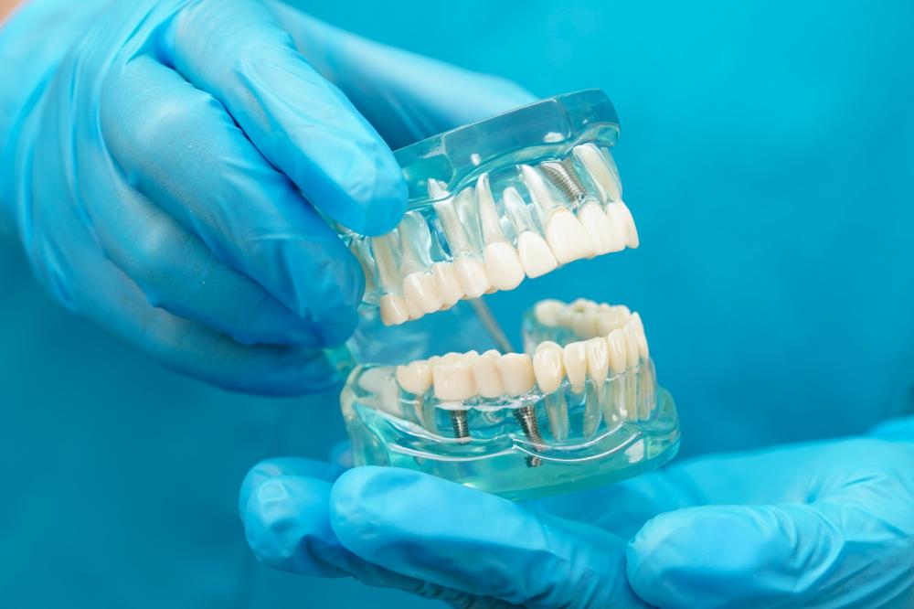 Benefits of Choosing Dental Bridges