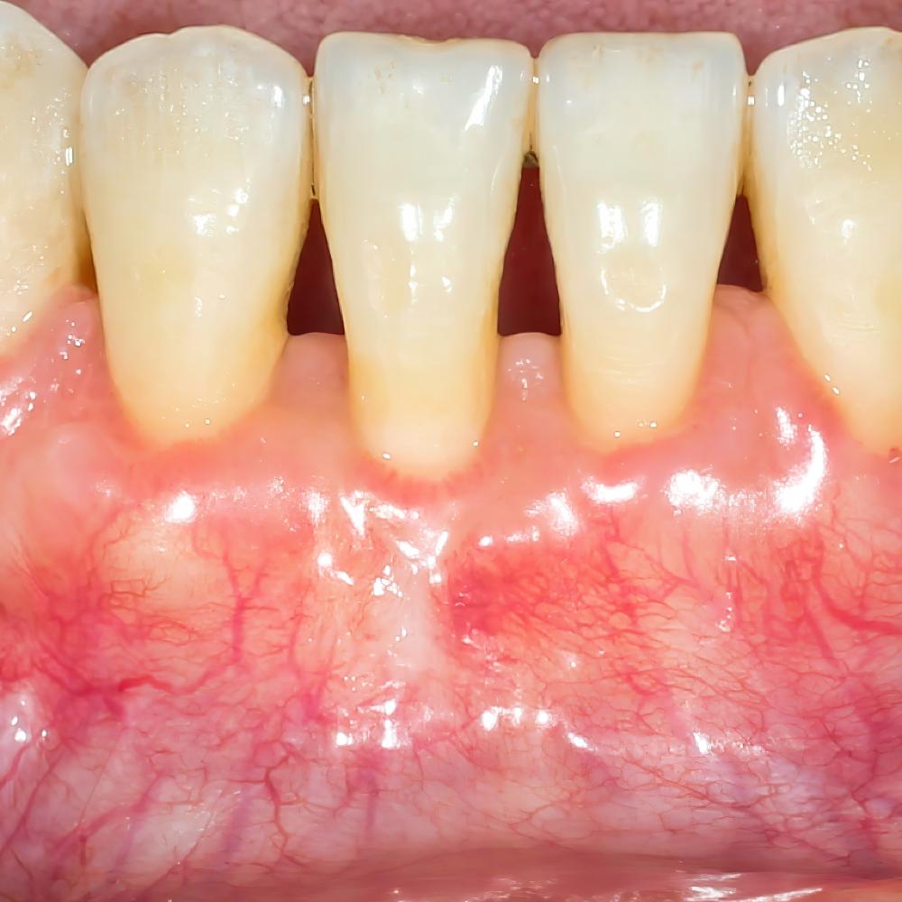 Tooth Filling Procedures and What to Expect