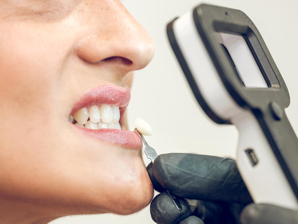 The Veneers Colorado Springs CO Process