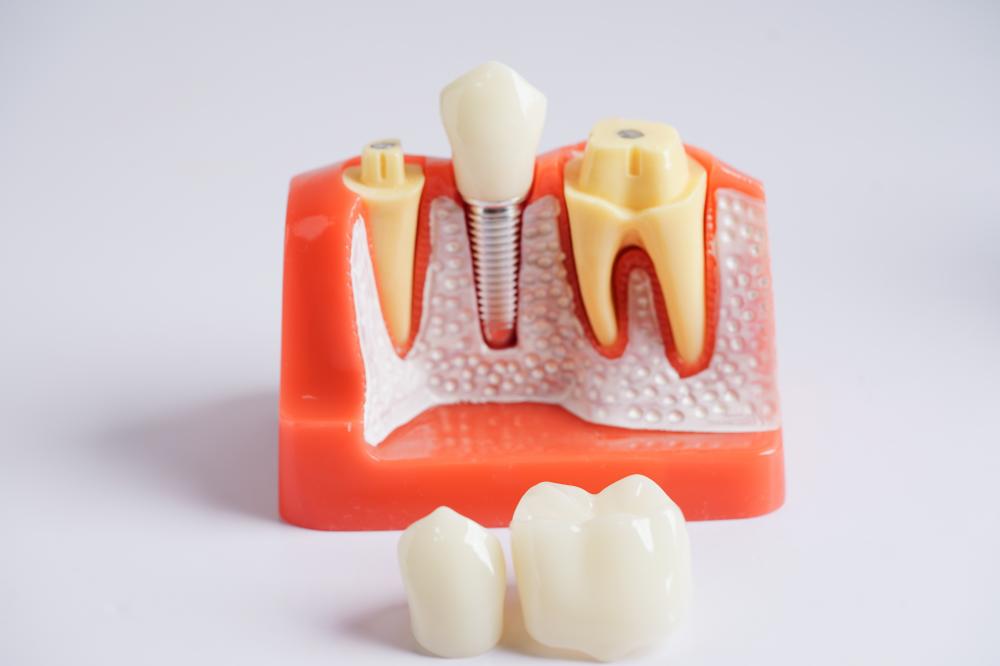 Dental implant procedure explained by Riverside dentists