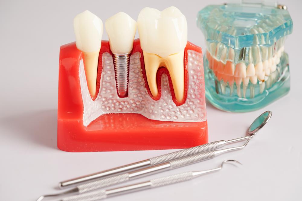Dental implant procedure with artificial tooth root