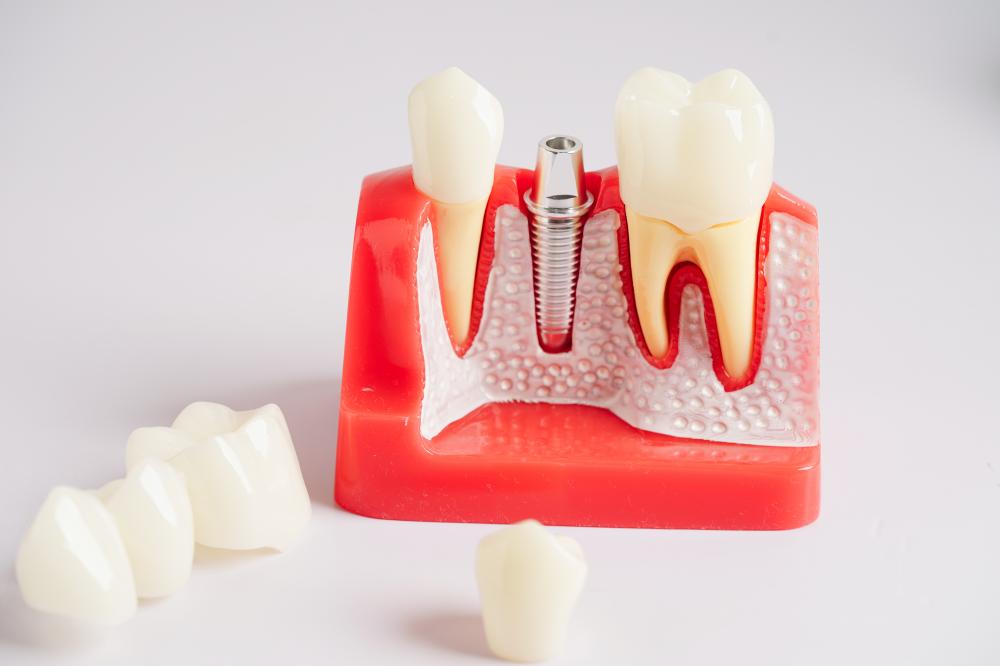 Artificial dental implant for tooth restoration