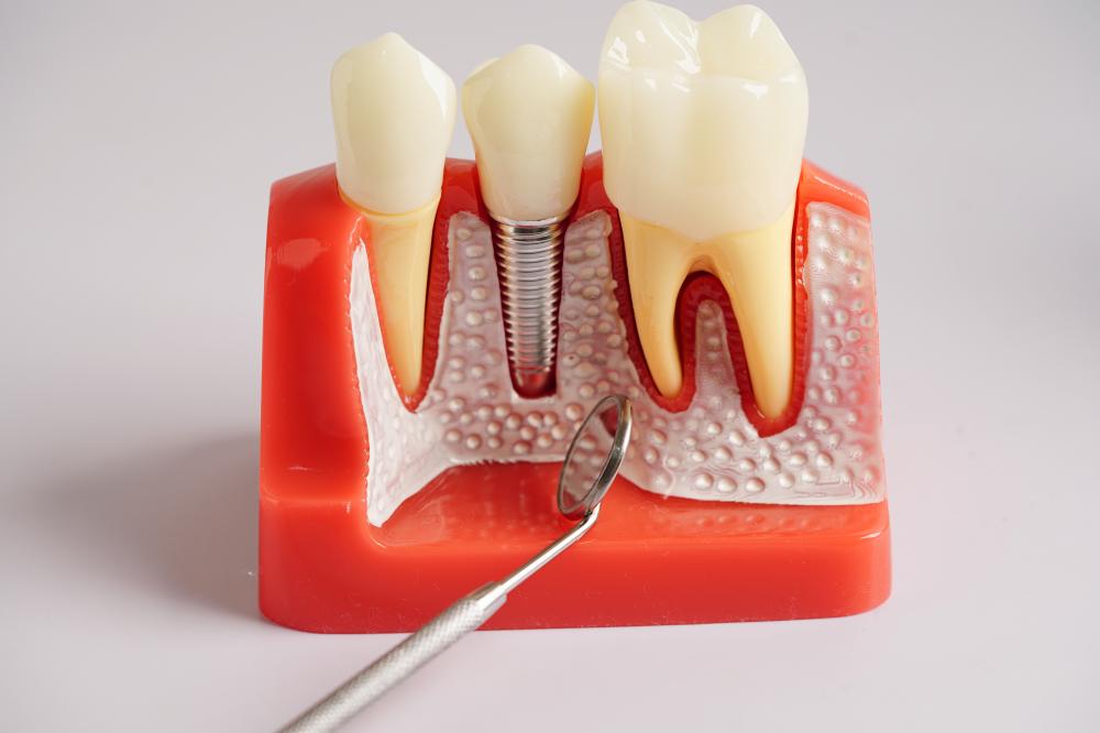 Detailed view of dental implant procedure highlighting costs and investment value
