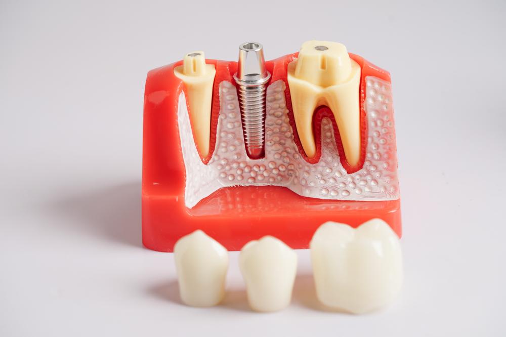 Artificial dental implant structure as a tooth root replacement