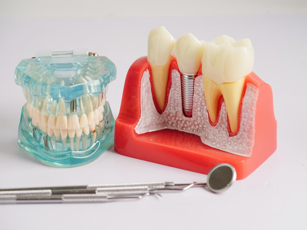 Precision Dental Implant Model Displaying Artificial Tooth Roots