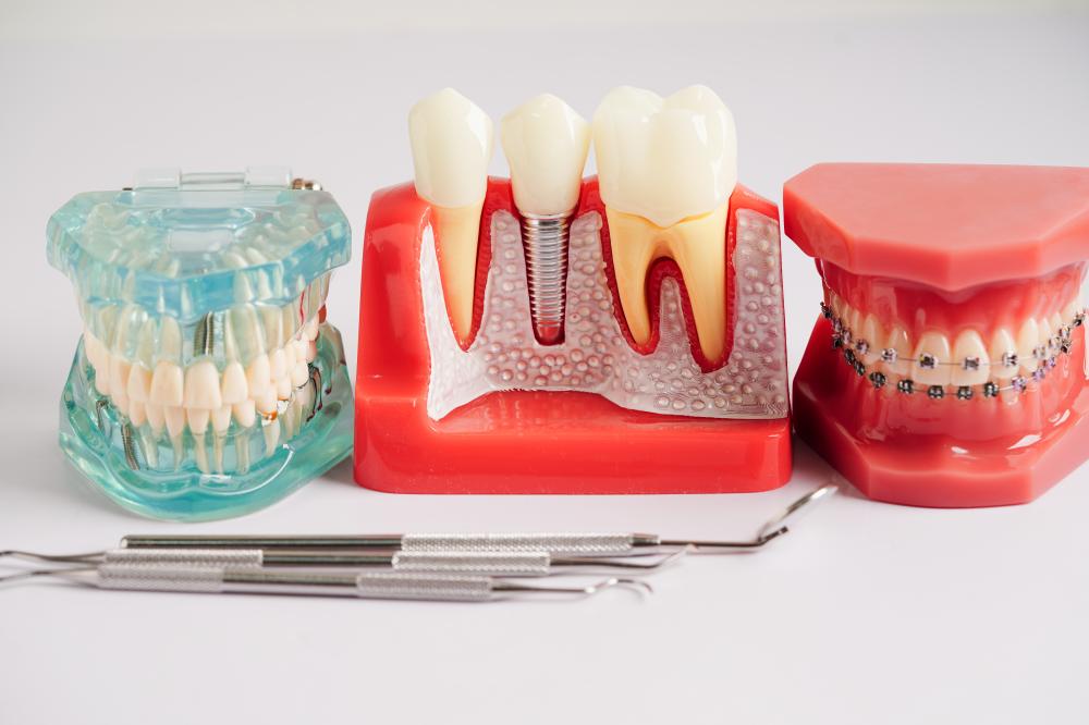 Advanced dental implant technology highlighted by Orlando dentist