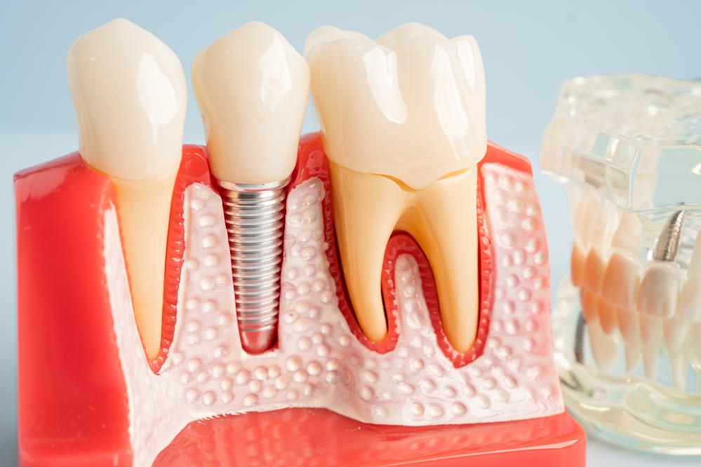 The Process of Getting Dental Implants