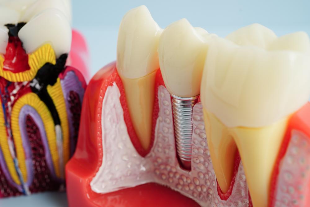 Why Dental Implants Might Be Right for You