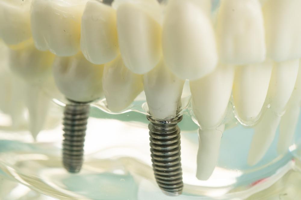 Benefits of Choosing Dental Implants