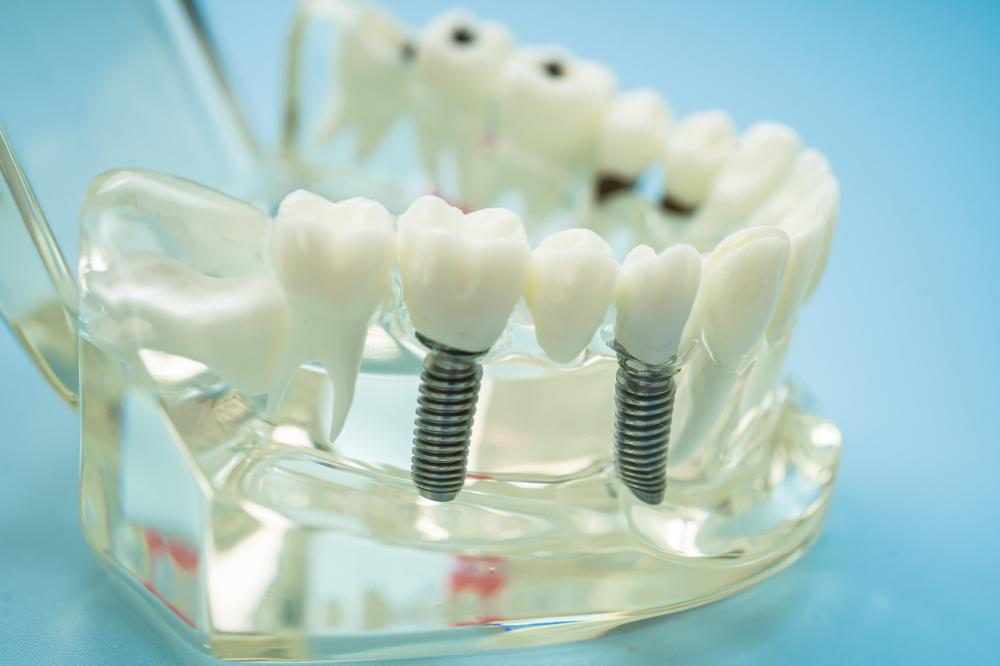 Common Questions About Dental Implants