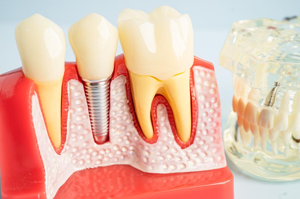 What Affects the Dental Implants Cost Lake Orion MI?
