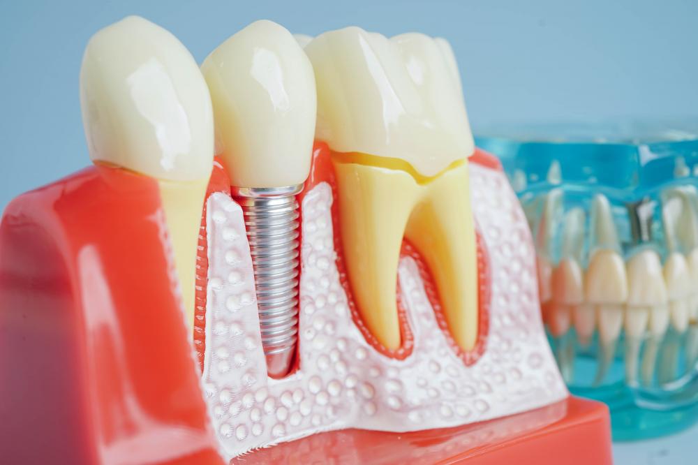 The Evolution of Dental Implants