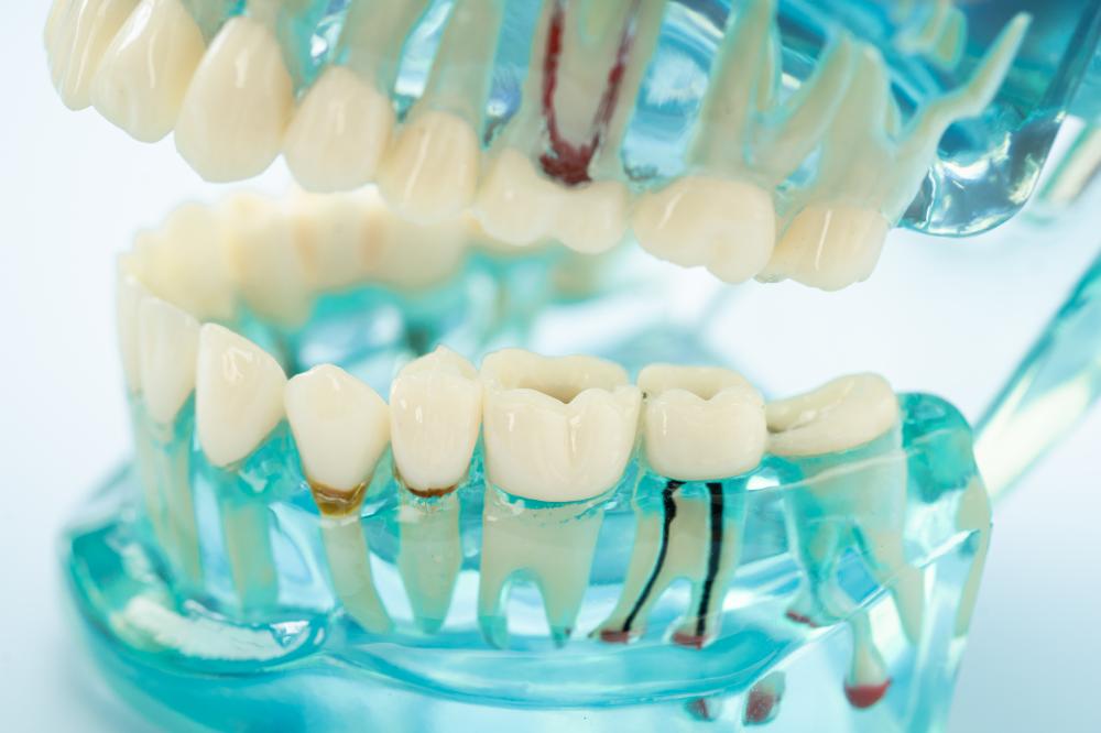 How Are Dental Bridges Placed?
