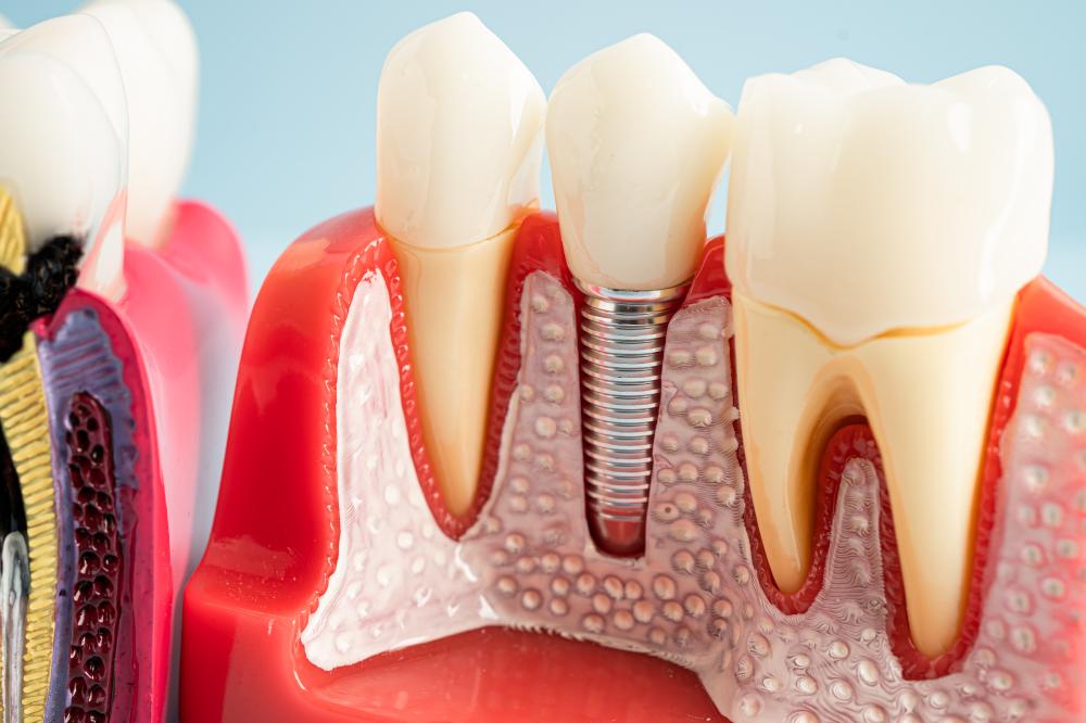 Challenges and Solutions in Dental Implants