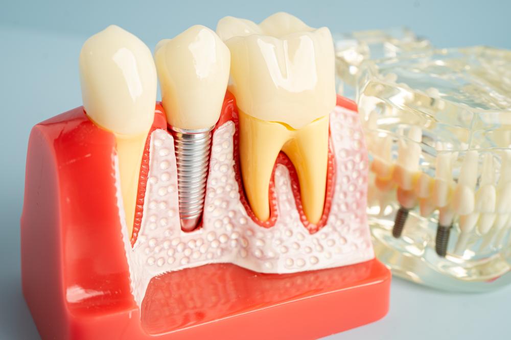 How Do Dental Implants Work?