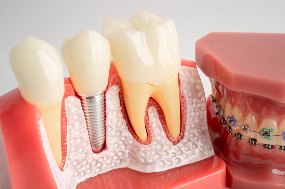 What to Expect from a Tooth Implant Procedure?
