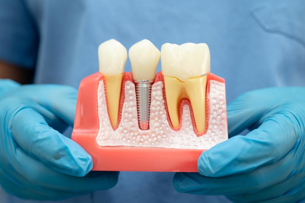 Are You a Candidate for Dental Implants?