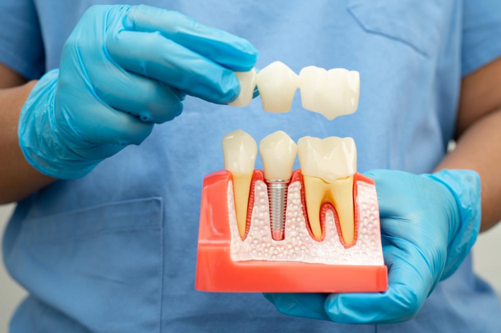 What Is the Process for Getting Dental Implants?