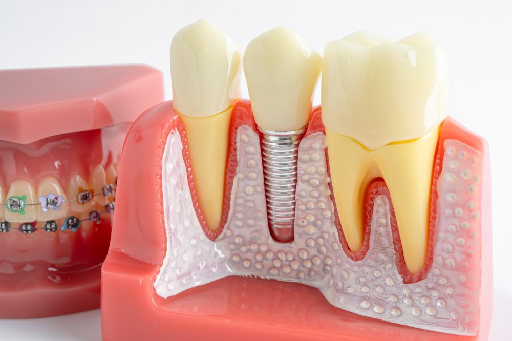 What to Expect with Tooth Implant Dawson Creek