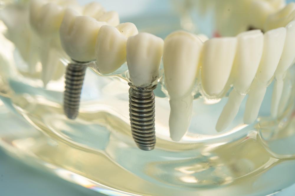 How Do Dental Implants in Dawson Creek Work?