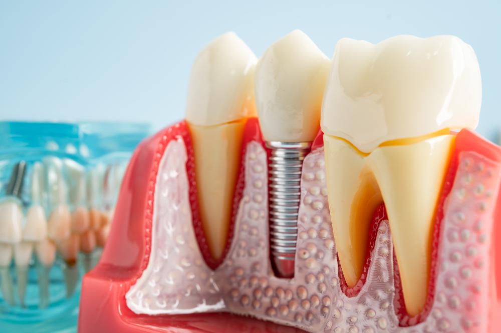 Unique Benefits of Dental Implants Dawson Creek
