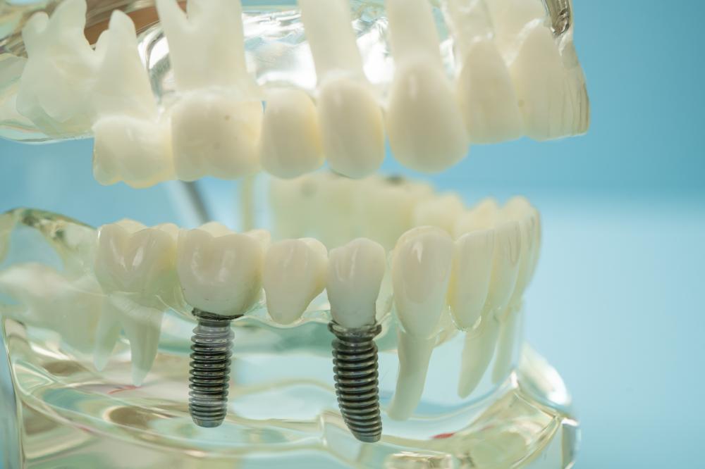 The Detailed Process of Getting Dental Implants