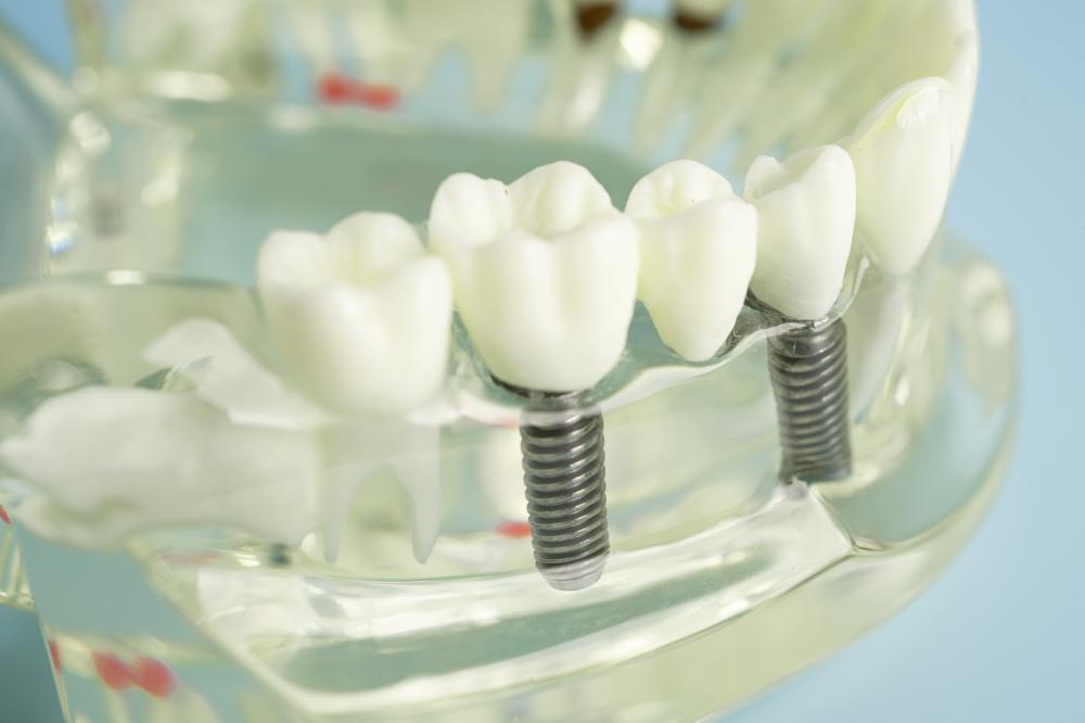 Benefits of Dental Implants