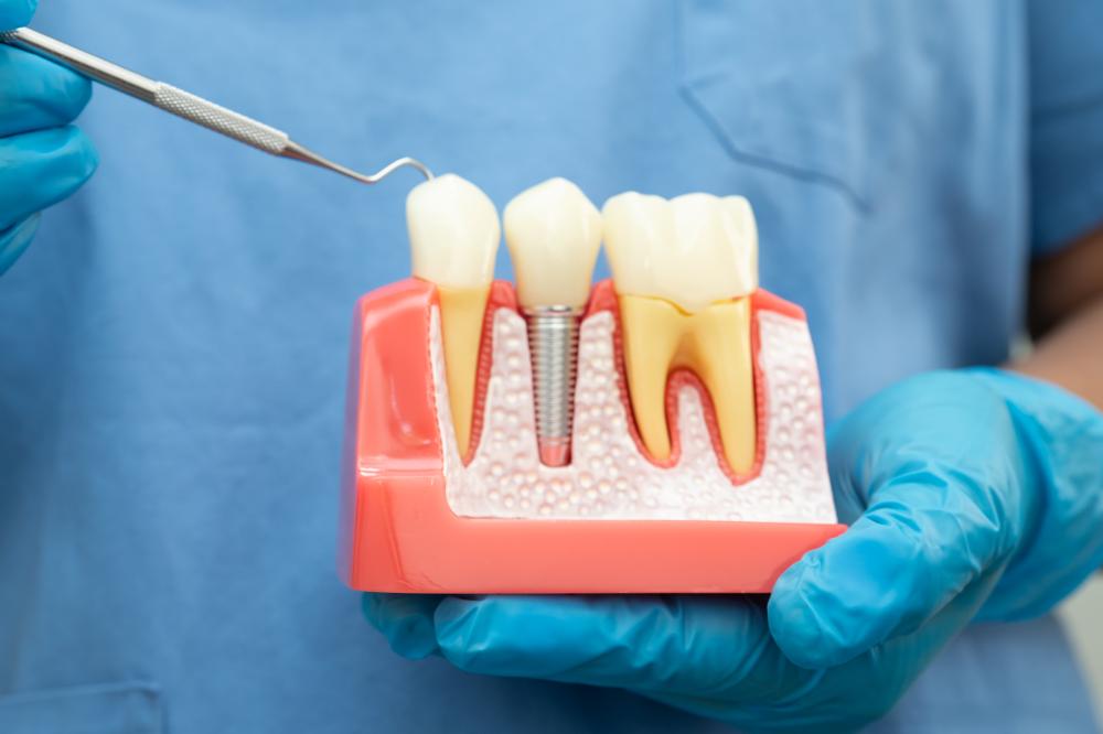 Process of Dental Implant Surgery