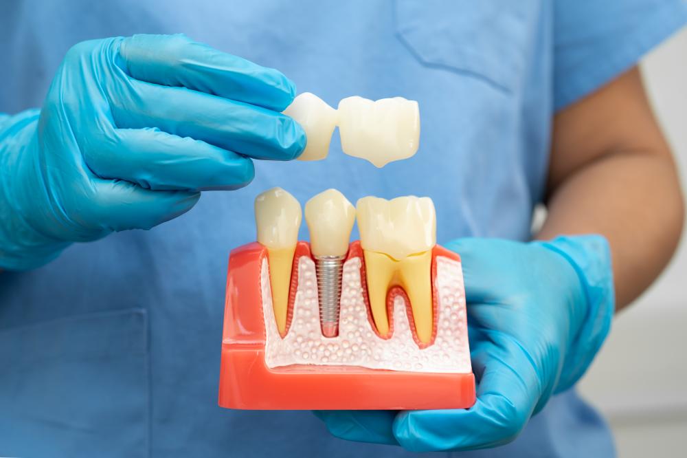 The Implant Process at Diamond Dental Centre