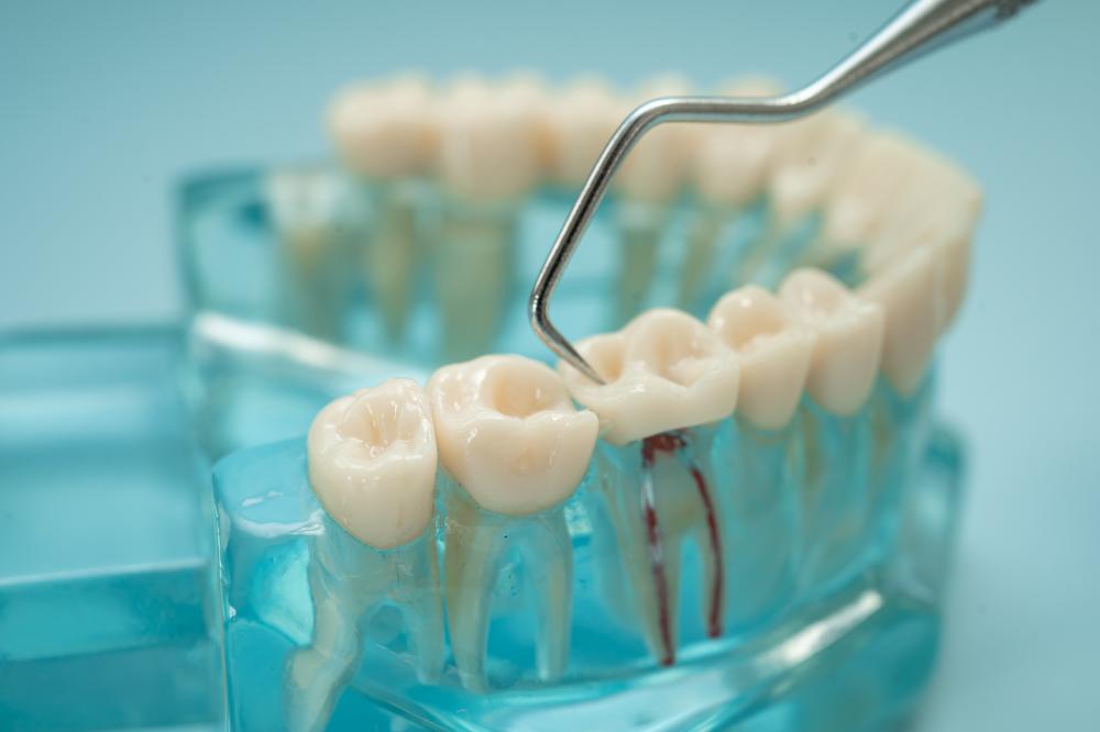 Benefits of Dental Bridges in White Rock