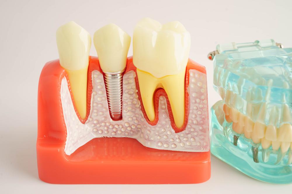 Benefits of Dental Implants: A Personal Perspective