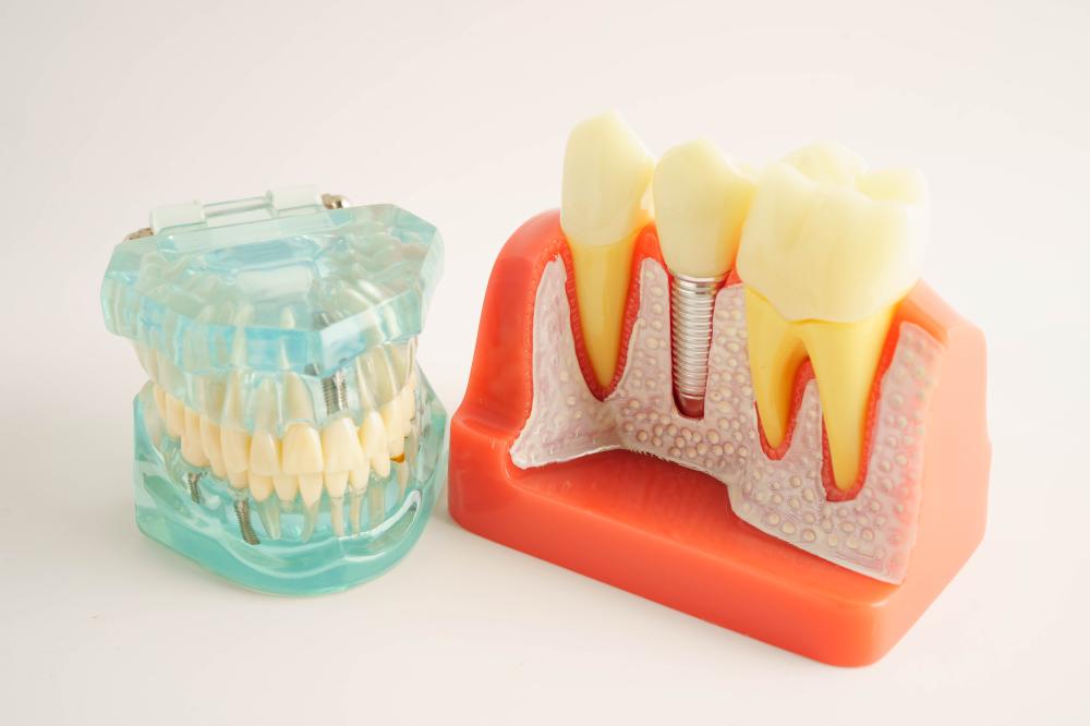 Factors Affecting Implant Cost