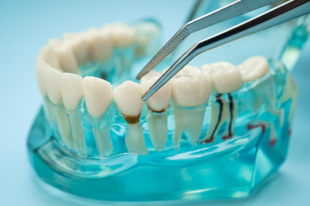 Types of Dental Bridges