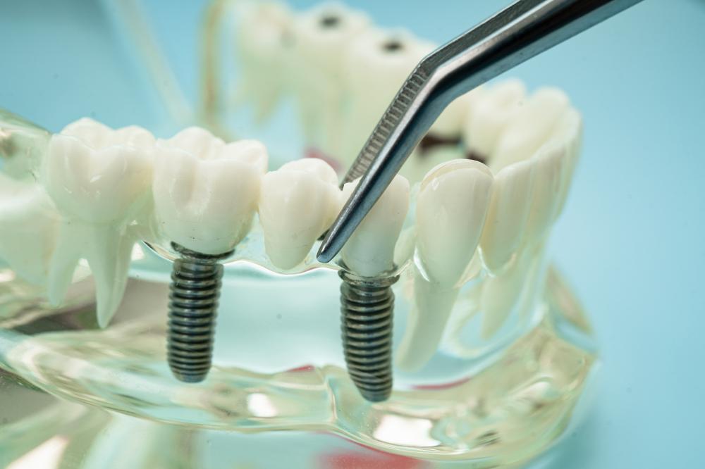 Benefits of Dental Implants